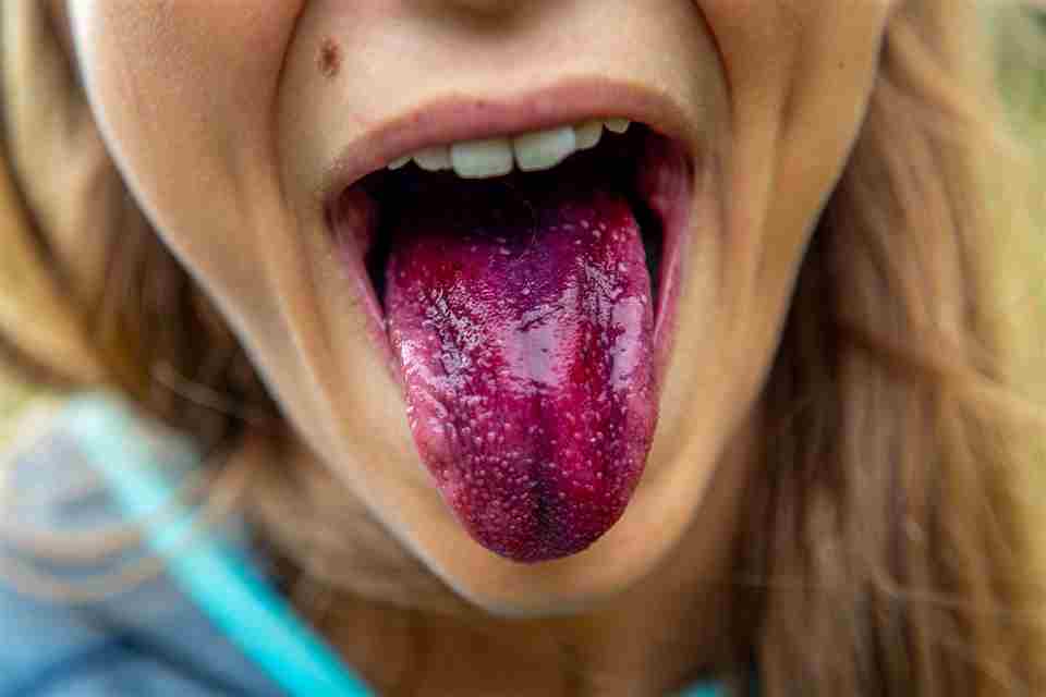 Proporcionado por Sportskeeda Salud y Fitness Una lengua inflamada es uno de los principales signos de deficiencia de B6. (Imagen vía Unsplash/Alex Guillaume)
