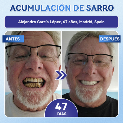 🦷𝐆𝐥𝐢𝐦𝐦𝐞𝐫𝐥𝐲®🎟️𝐓𝐢𝐝𝐞𝐠𝐥𝐮𝐬𝐢𝐛 𝐃𝐢𝐞𝐧𝐭𝐞𝐬 𝐘 𝐄𝐧𝐜í𝐚𝐬 𝐑𝐞𝐩𝐚𝐫𝐚𝐫 𝐌𝐢𝐜𝐫𝐨𝐧𝐞𝐞𝐝𝐥𝐞 𝐏𝐚𝐫𝐜𝐡𝐞 |𝑇𝑖𝑟𝑎𝑠 𝑑𝑒𝑛𝑡𝑎𝑙𝑒𝑠 𝑐𝑜𝑛 𝑡𝑒𝑐𝑛𝑜𝑙𝑜𝑔í𝑎 𝑎𝑣𝑎𝑛𝑧𝑎𝑑𝑎 𝑑𝑒 𝑎𝑐𝑡𝑖𝑣𝑎𝑐𝑖ó𝑛 𝑑𝑒 𝑐é𝑙𝑢𝑙𝑎𝑠 𝑚𝑎𝑑𝑟𝑒