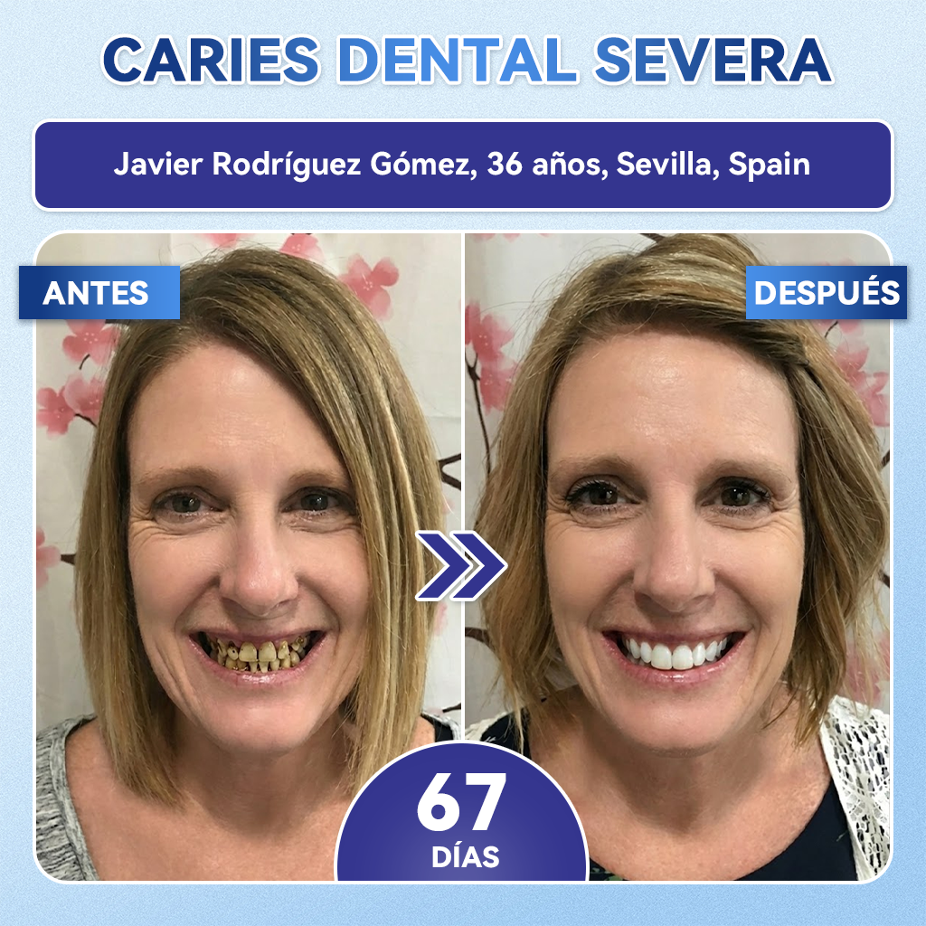 🦷𝐆𝐥𝐢𝐦𝐦𝐞𝐫𝐥𝐲®🎟️𝐓𝐢𝐝𝐞𝐠𝐥𝐮𝐬𝐢𝐛 𝐃𝐢𝐞𝐧𝐭𝐞𝐬 𝐘 𝐄𝐧𝐜í𝐚𝐬 𝐑𝐞𝐩𝐚𝐫𝐚𝐫 𝐌𝐢𝐜𝐫𝐨𝐧𝐞𝐞𝐝𝐥𝐞 𝐏𝐚𝐫𝐜𝐡𝐞 |𝑇𝑖𝑟𝑎𝑠 𝑑𝑒𝑛𝑡𝑎𝑙𝑒𝑠 𝑐𝑜𝑛 𝑡𝑒𝑐𝑛𝑜𝑙𝑜𝑔í𝑎 𝑎𝑣𝑎𝑛𝑧𝑎𝑑𝑎 𝑑𝑒 𝑎𝑐𝑡𝑖𝑣𝑎𝑐𝑖ó𝑛 𝑑𝑒 𝑐é𝑙𝑢𝑙𝑎𝑠 𝑚𝑎𝑑𝑟𝑒