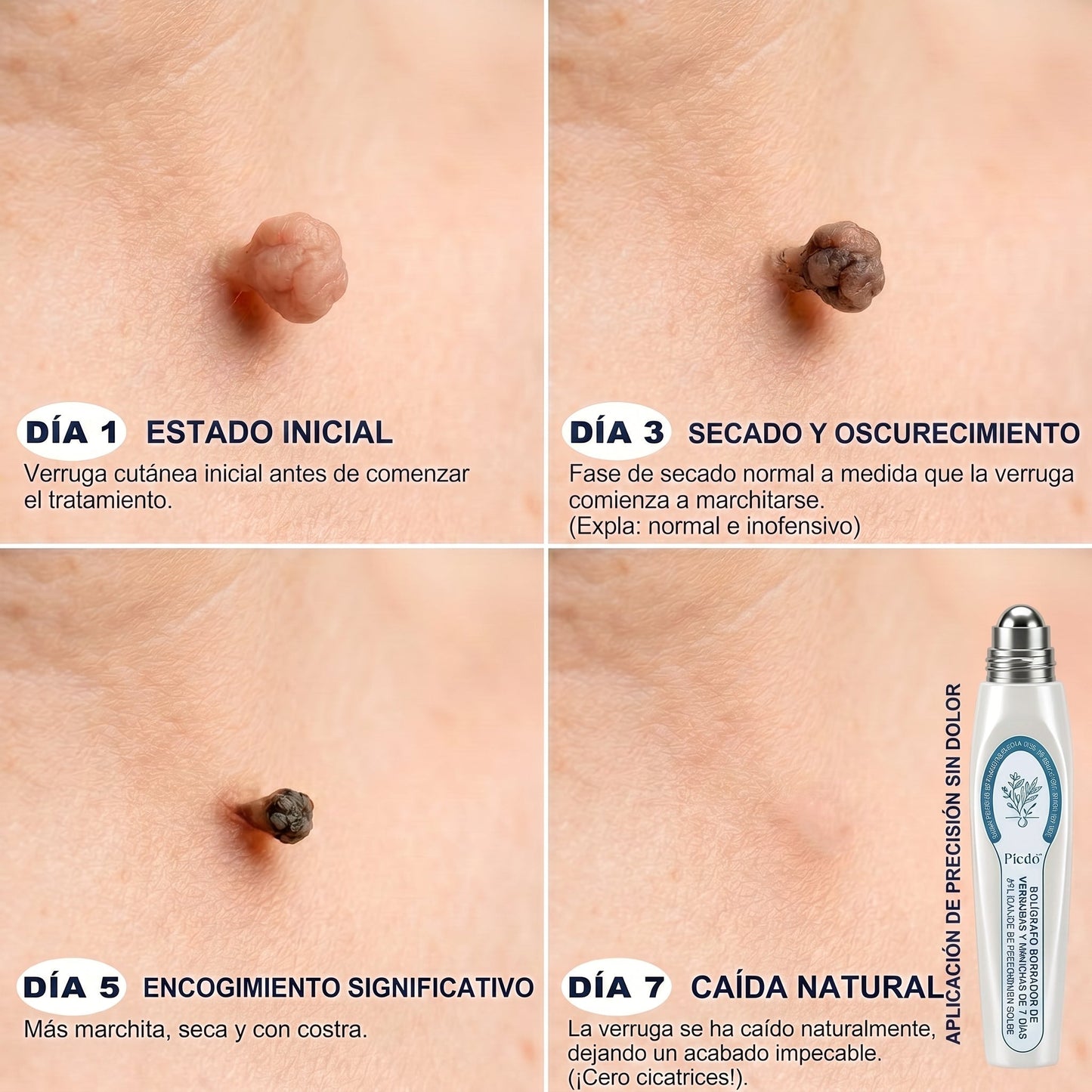 𝐏𝐢𝐜𝐝𝐨® 🚢Borrador de Verrugas y Manchas en 7 Días (𝐀𝐩𝐥𝐢𝐜𝐚𝐝𝐨𝐫 𝐫𝐨𝐥𝐥-𝐨𝐧: 𝐬𝐢𝐧 𝐝𝐨𝐥𝐨𝐫 𝐧𝐢 𝐜𝐢𝐜𝐚𝐭𝐫𝐢𝐜𝐞𝐬)✨