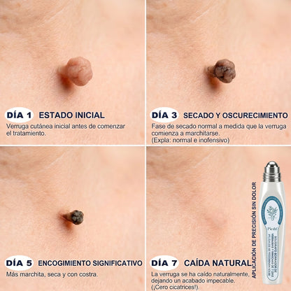 𝐏𝐢𝐜𝐝𝐨® 🚢Borrador de Verrugas y Manchas en 7 Días (𝐀𝐩𝐥𝐢𝐜𝐚𝐝𝐨𝐫 𝐫𝐨𝐥𝐥-𝐨𝐧: 𝐬𝐢𝐧 𝐝𝐨𝐥𝐨𝐫 𝐧𝐢 𝐜𝐢𝐜𝐚𝐭𝐫𝐢𝐜𝐞𝐬)✨