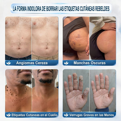𝐏𝐢𝐜𝐝𝐨® 🚢Borrador de Verrugas y Manchas en 7 Días (𝐀𝐩𝐥𝐢𝐜𝐚𝐝𝐨𝐫 𝐫𝐨𝐥𝐥-𝐨𝐧: 𝐬𝐢𝐧 𝐝𝐨𝐥𝐨𝐫 𝐧𝐢 𝐜𝐢𝐜𝐚𝐭𝐫𝐢𝐜𝐞𝐬)✨